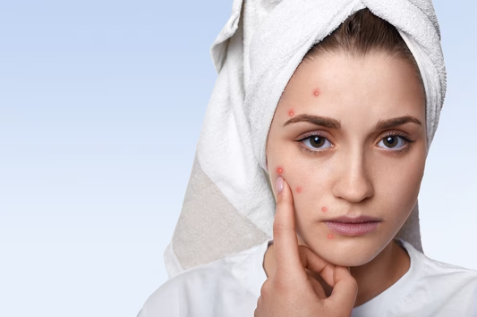 6 Best Acne Scar Removal Products in India